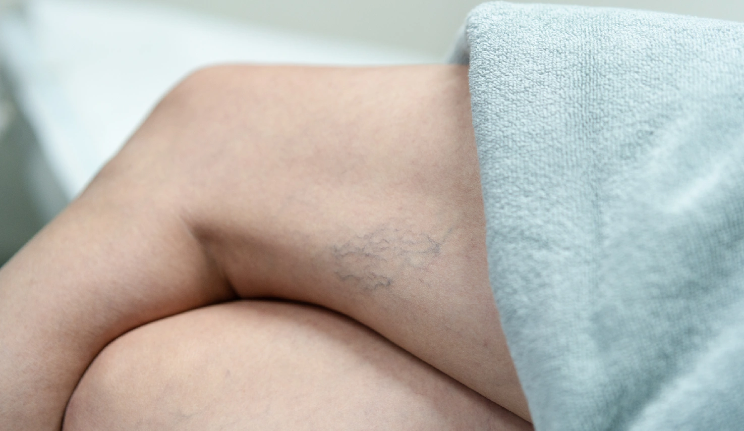 Varicose veins