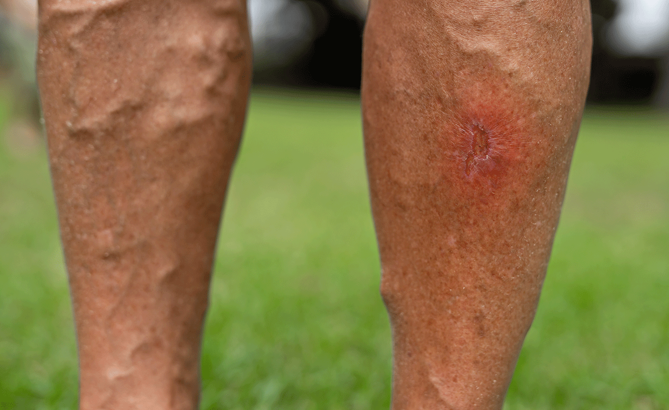 Do You Need Varicose Vein Surgery? Signs & Tests