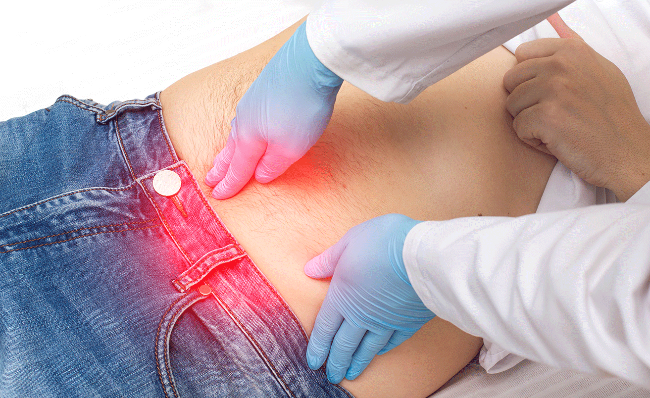 What Are the Different Types of Hernias?