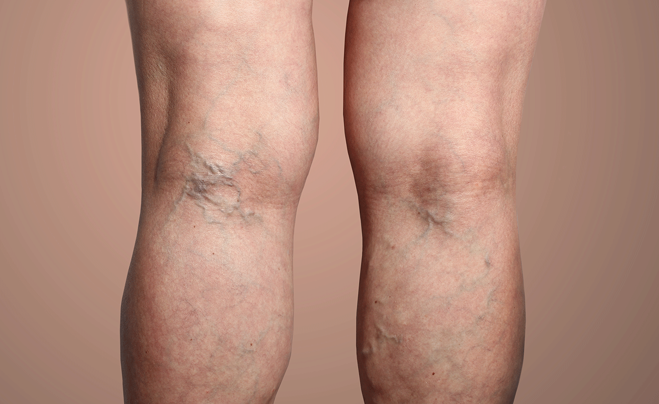 Are Spider Veins and Varicose Veins the Same?