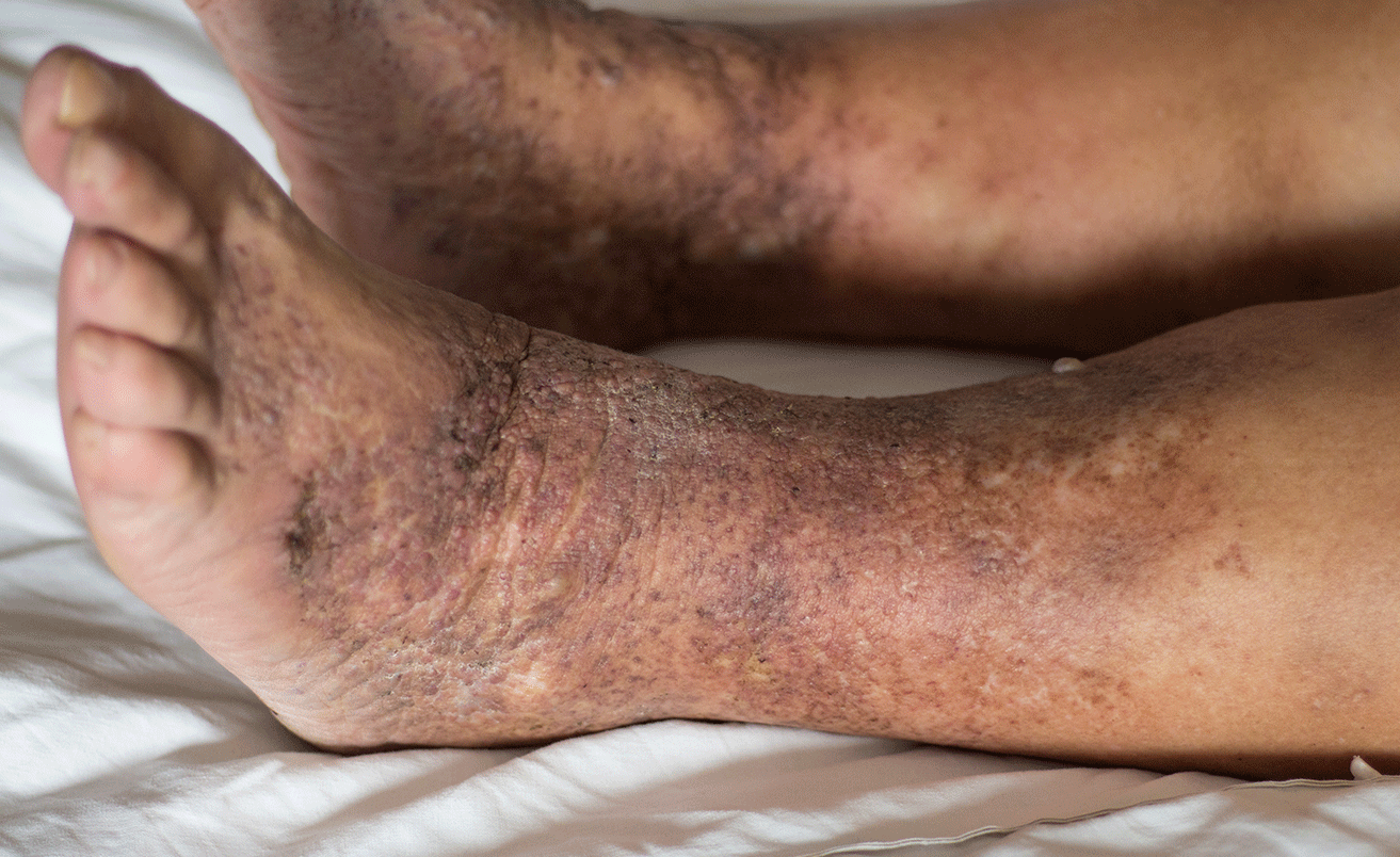 Venous Insufficiency: Causes, Symptoms, Treatment