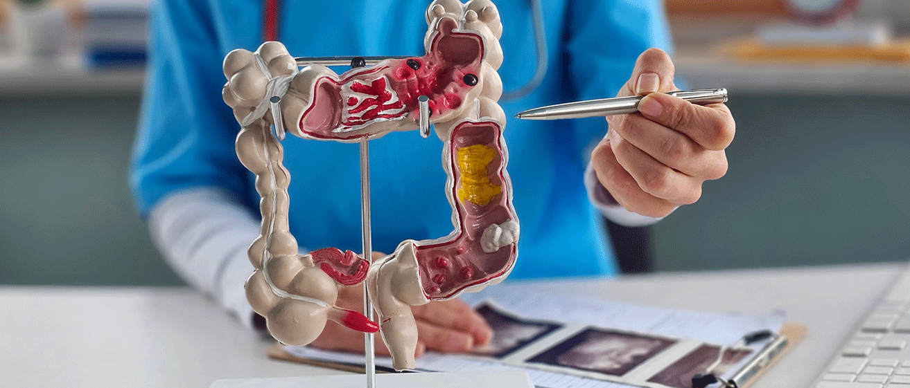 A doctor pointing to an anatomical diagram of a colon