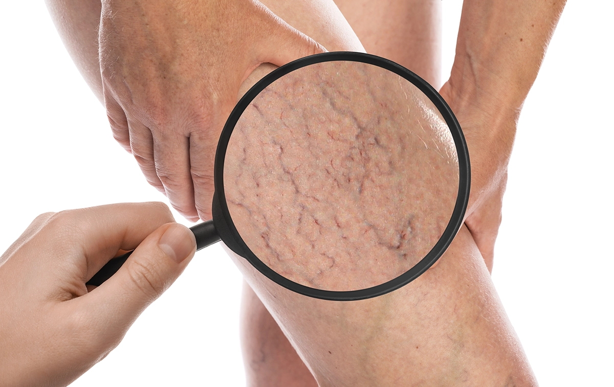 Magnifying glass pointing at varicose veins on leg