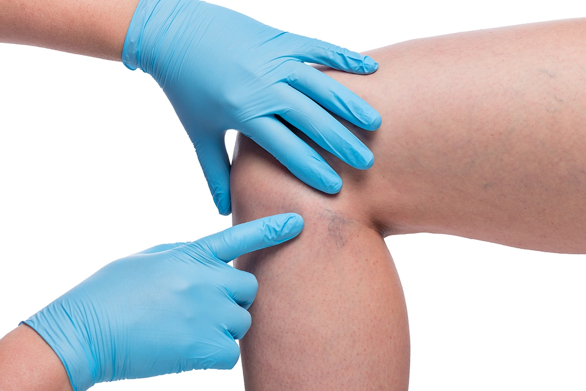 Early Signs of Venous Disease You Should Not Ignore