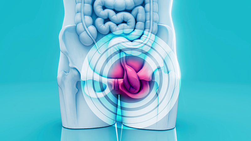 Conceptual 3D illustration of a human hernia