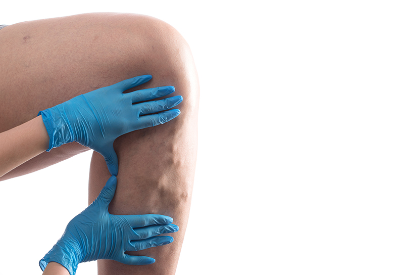 Vascular specialist examining visible varicose veins on a patient's leg