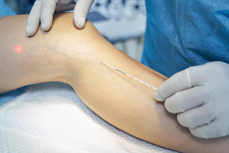 Vascular specialist performing minimally invasive laser vein removal on a patient's leg to treat varicose veins