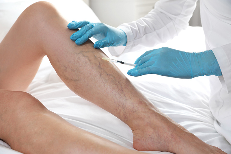 Doctor providing varicose vein treatment to patient’s leg