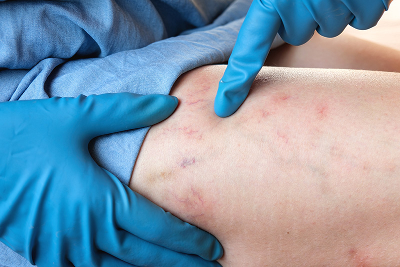 A professional assessment of varicose veins