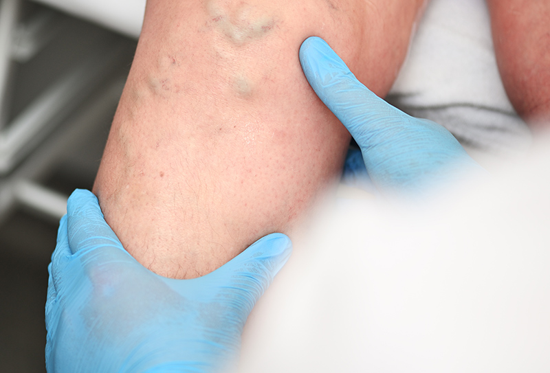 A patient with varicose veins