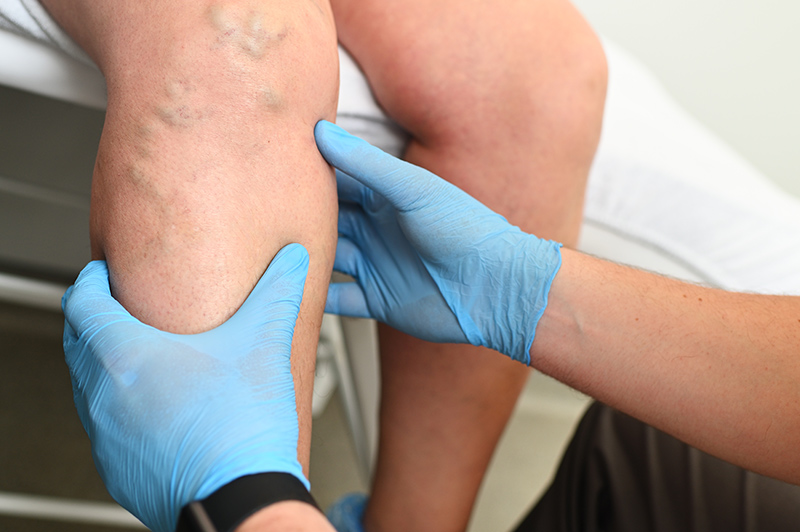 Doctor checking patient with varicose veins