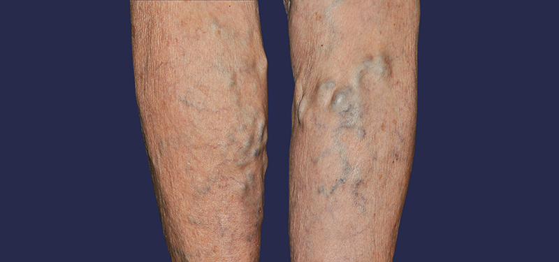 Varicose veins on legs