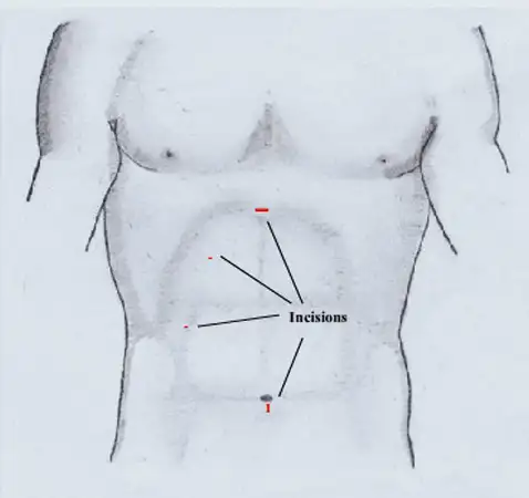 Incision diagram