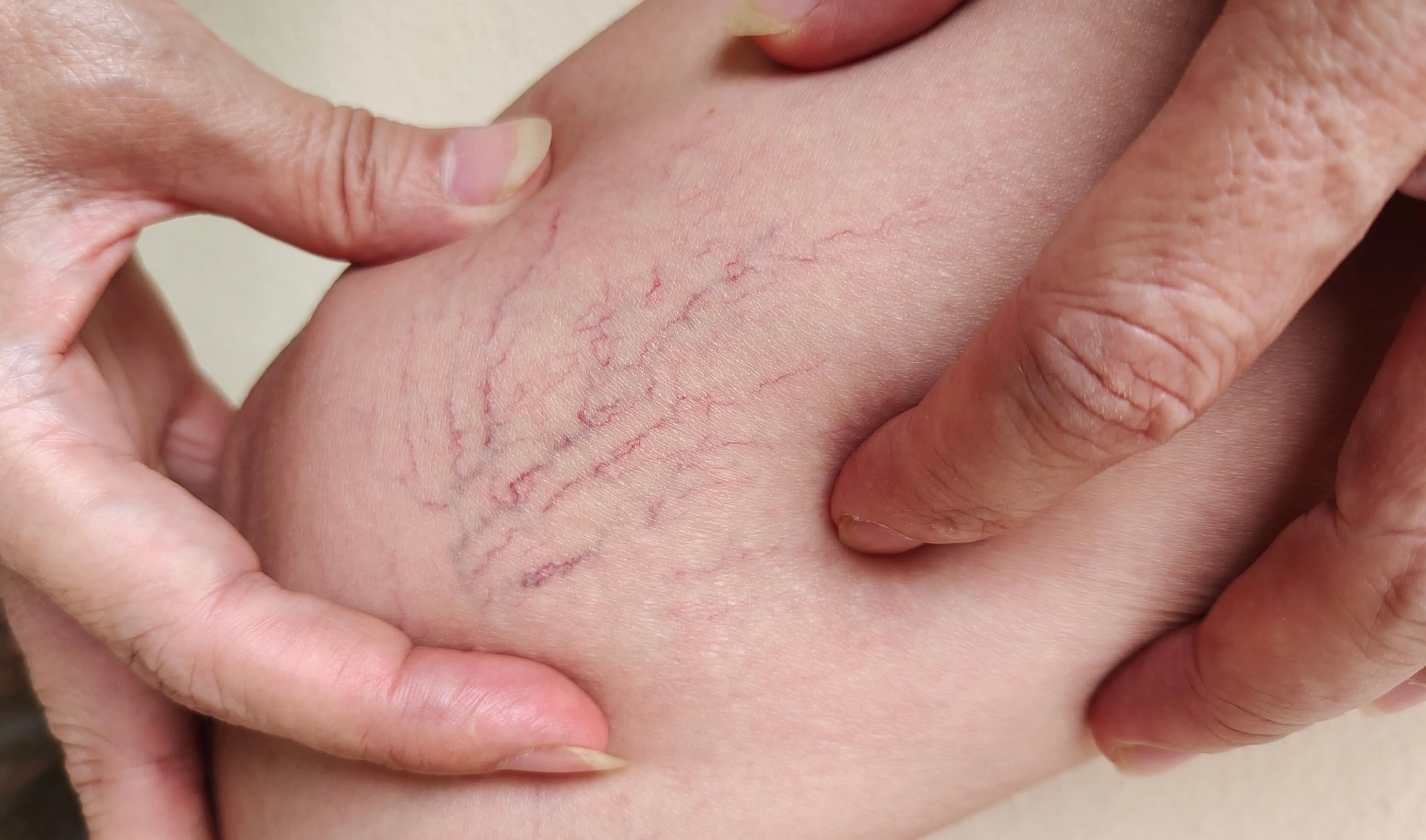 Spider Veins Treatment page header